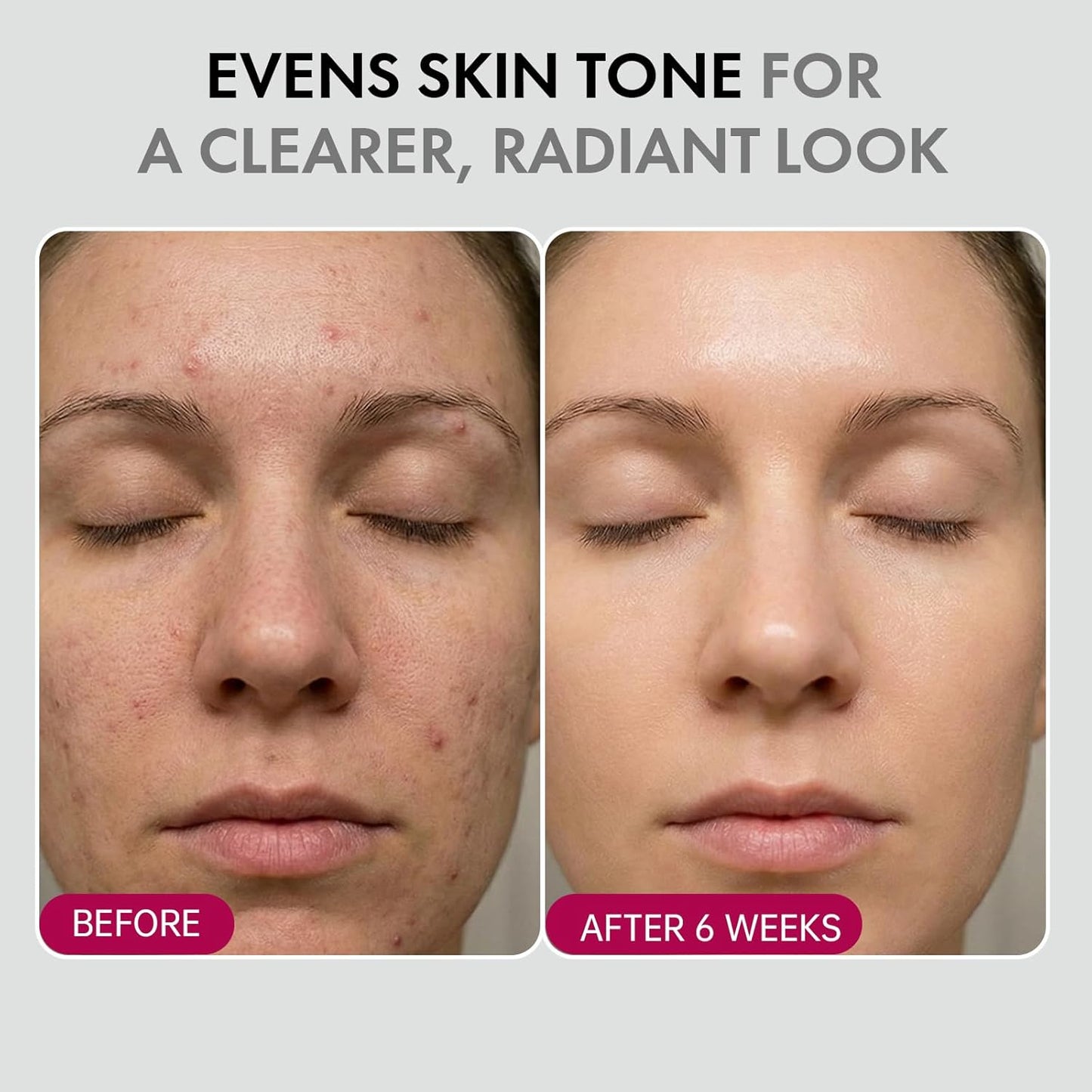 ✨ Spot Removal | Acne Treatment | Anti-Aging | Melanin Reduction | Skin Smoothing | Hydrating | Brightening & Fine Line Diminishing | Skin Renewing Cream