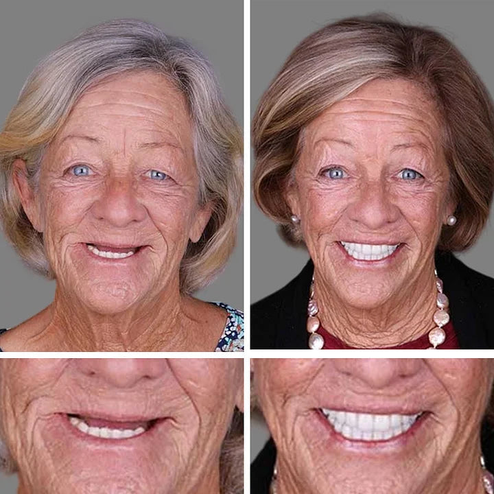 SmileLock – Premium Full Denture Solution