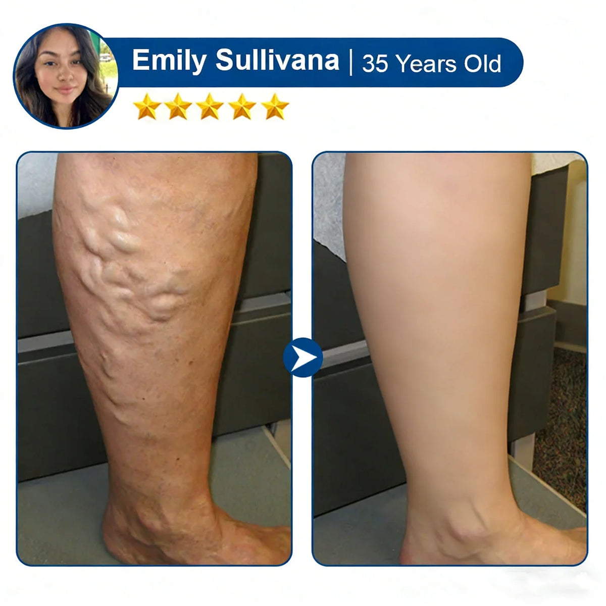 VenoLume – Diosmin & Hesperidin Microneedle Vein Patch