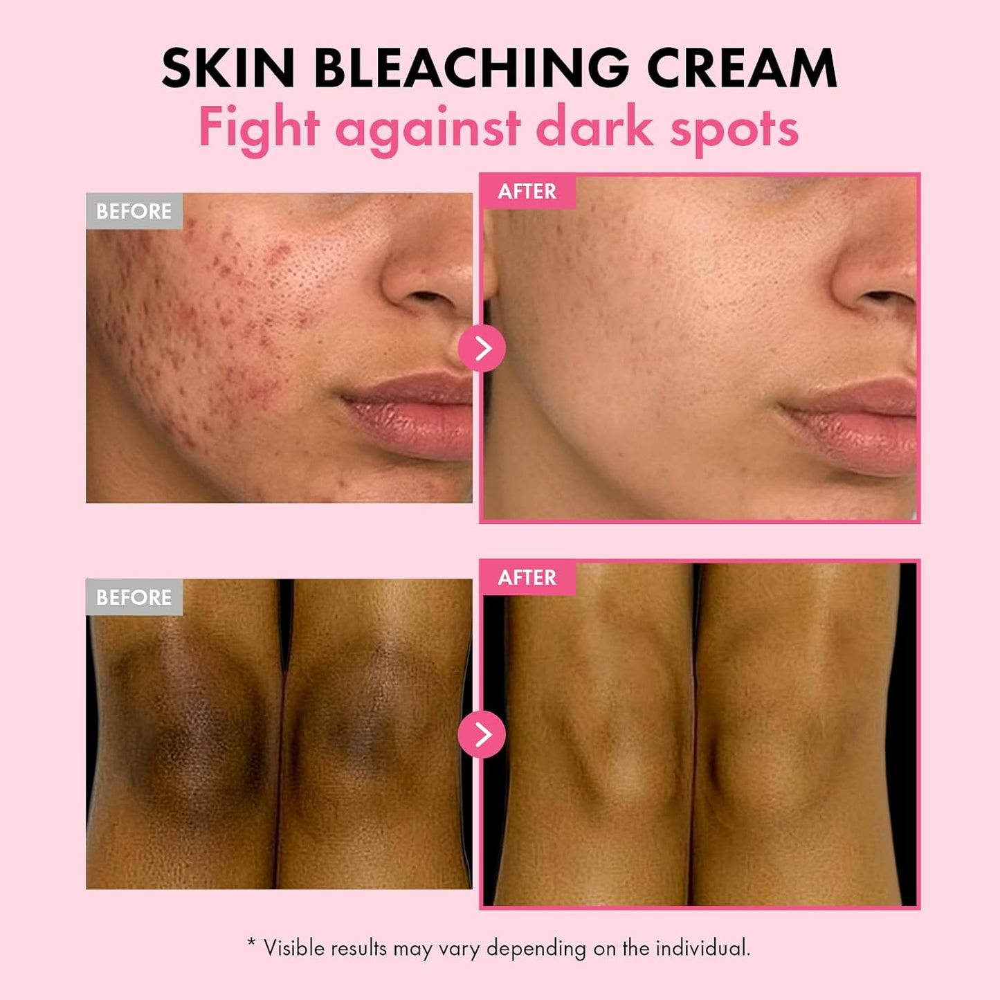 ✨ Spot Removal | Acne Treatment | Anti-Aging | Melanin Reduction | Skin Smoothing | Hydrating | Brightening & Fine Line Diminishing | Skin Renewing Cream